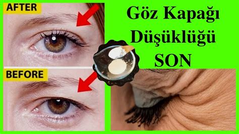 Dolgu İle Gençleşin: Ciltteki Kırışıklıklar İçin Etkili Çözümler