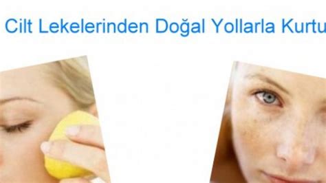 Çilt Lekelerine Doğal Çözümler