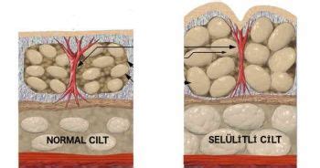 Selülit Nedir ve Nasıl Oluşur?