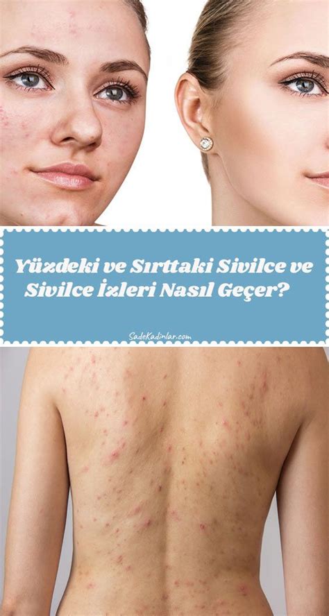 Sivilce İzleri Nasıl Geçer?