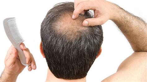 Erkeklerde Saç Dökülmesi Nedenleri ve Çözümleri