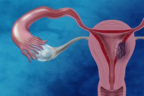 Endometrial Kanser