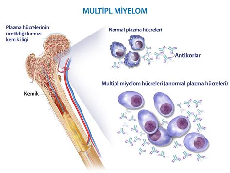 Multipl Miyelom