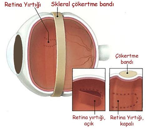 Retina Dekolmanı ve Retina Yırtılması