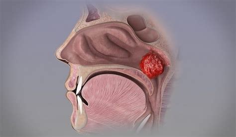 Geniz Eti (Adenoid)