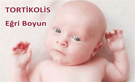 Eğri Boyun Hastalığı (Tortikolis)