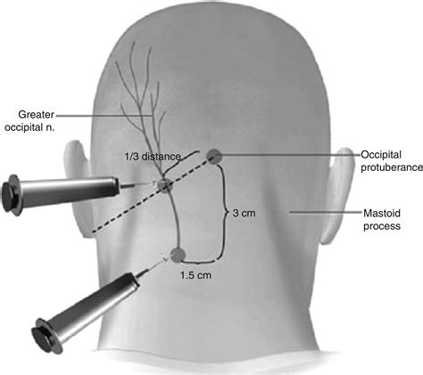 Oksipital Nevralji