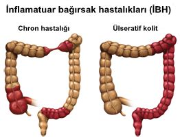 Crohn Hastalığı ve Ülseratif Kolit (İltihabi Bağırsak Hastalıkları)