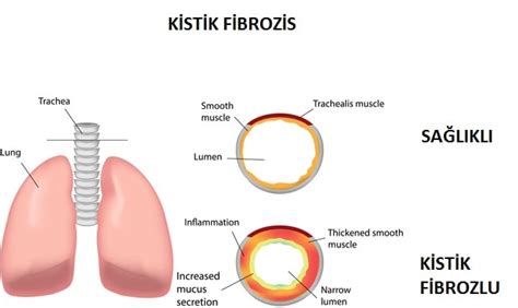 Kistik Fibrozis