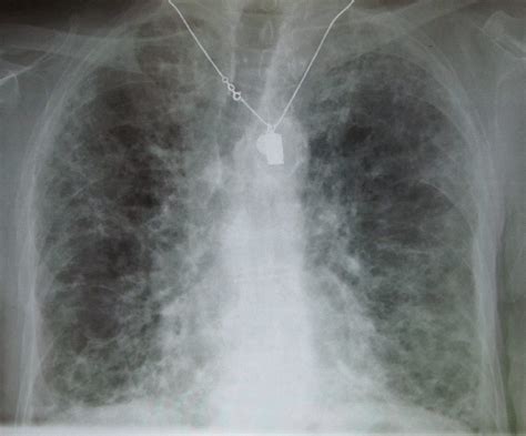 Pulmoner Fibrozis