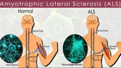 ALS (Amyotrofik Lateral Skleroz)