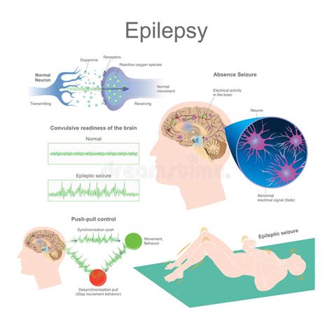 Epilepsi