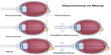 Astigmat, Miyop ve Hipermetrop Nedir?