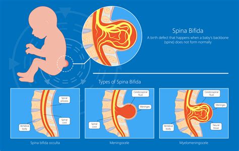 Spina Bifida