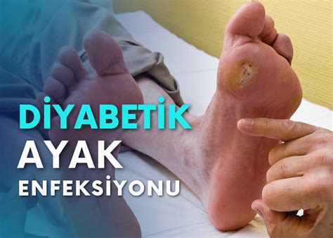 Diyabetik ve Charcot Ayak Cerrahisi